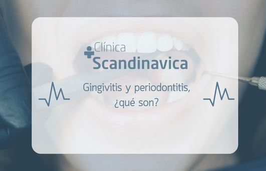 gingivitis y periodontitits en las palmas 